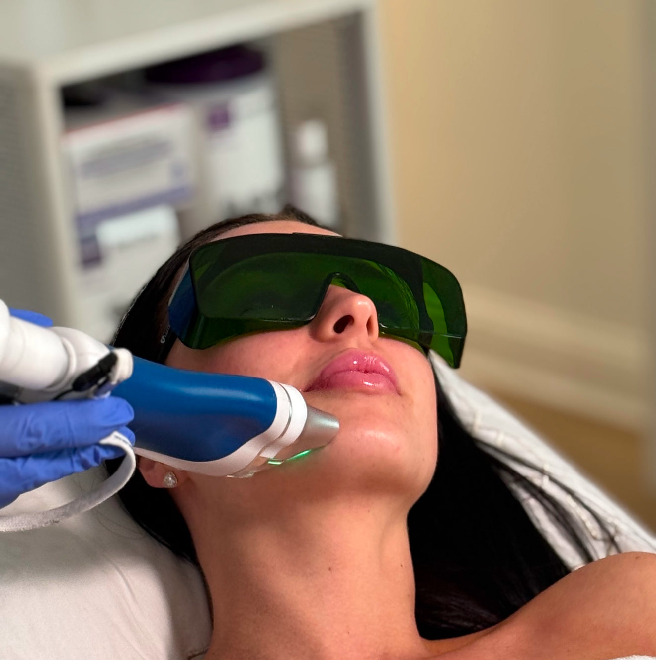Chin laser hair removal ( includes 6 sessions)