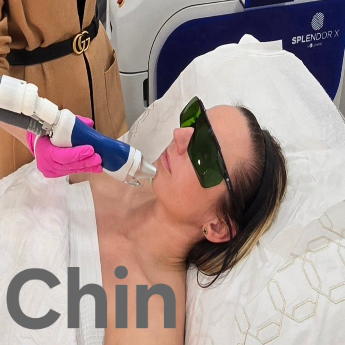 Chin laser hair removal ( includes 6 sessions)