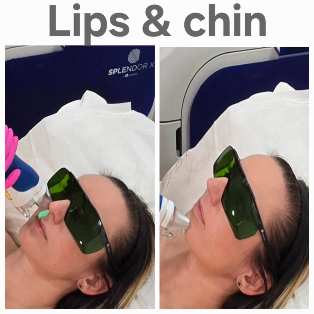 Lip and chin laser hair removal bundle ( includes 6 sessions)
